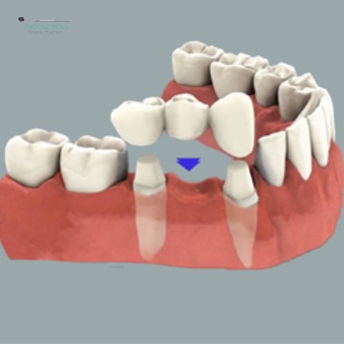 Crowns and Bridges - Paradise Road Dentistry Newlands