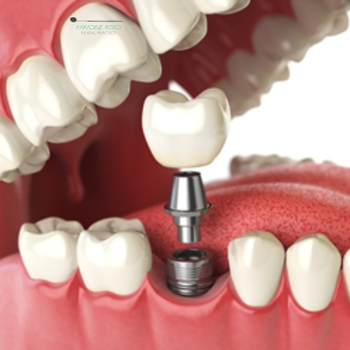 Dental Implants - Paradise Road Dentist Practice in Newlands