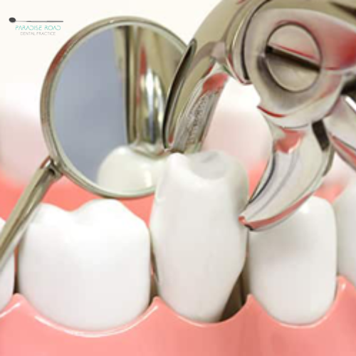 Extractions - Paradise Road Dentist Practice in Newlands