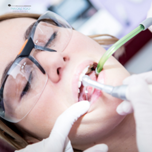 White Fillings - Paradise Road Dentistry