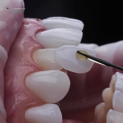 Veneers - Paradise Road Dentist Practice