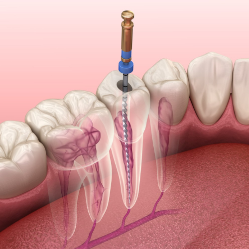 Endodontic Treatment serrvice in Newllands, Cape Town