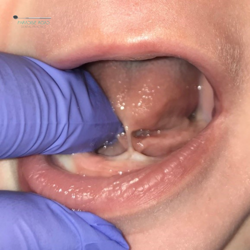 Tongue & Lip Tie Assessment at Paradise Road Dental Practice in Newlands, Cape Town